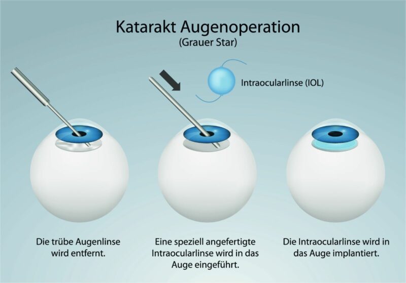 Katarakt (Grauer Star) Operationen, Therapien & Behandlungen